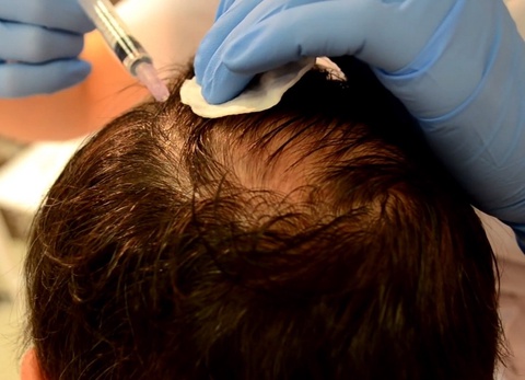 Внутрикожное введение озоно-кислородной смеси в область волосистой части головы при аллопеции - 330 ₽