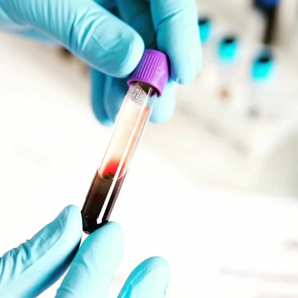 Анализ крови на билирубин общий - 200 ₽, заказать онлайн.